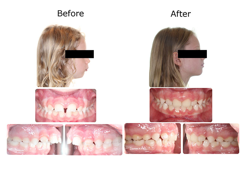 Invisalign® First - Bella Smile