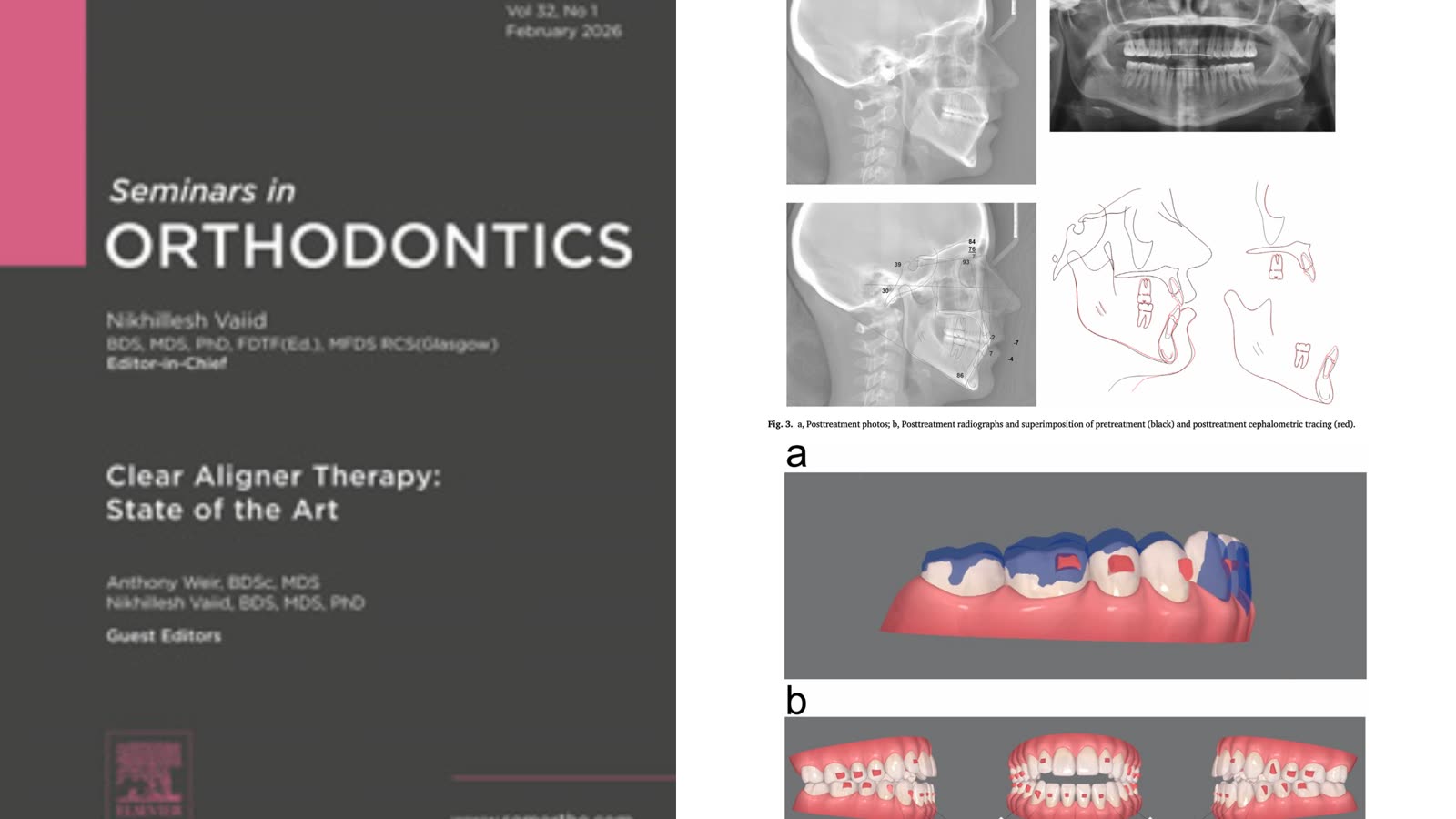 The Seminars in Orthodontics issue on clear aligner therapy, with radiographs and treatment planning figures from the paper