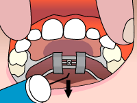 All about Palate Expanders – TruCare Dentistry